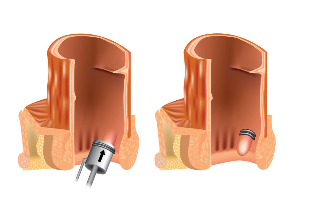 legatura elastica e scleroterapia emorroidi presso centro medico buonarroti